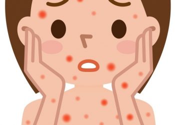 Работающим ульяновцам сделают прививку против кори