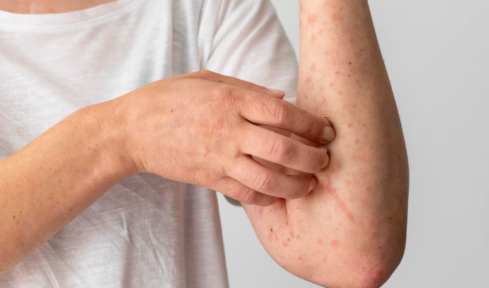 В Димитровграде из-за кори продлили ограничительные меры