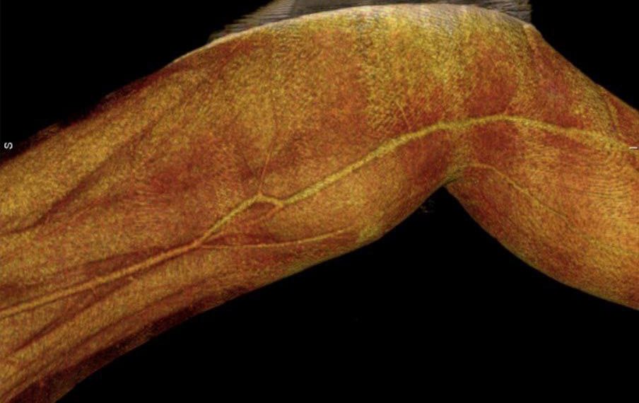Ульяновские хирурги спасли ногу бойца СВО от ампутации
