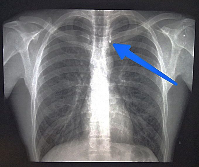 Ульяновский хирург Кучиц спас израненного осколками бойца СВО на передовой