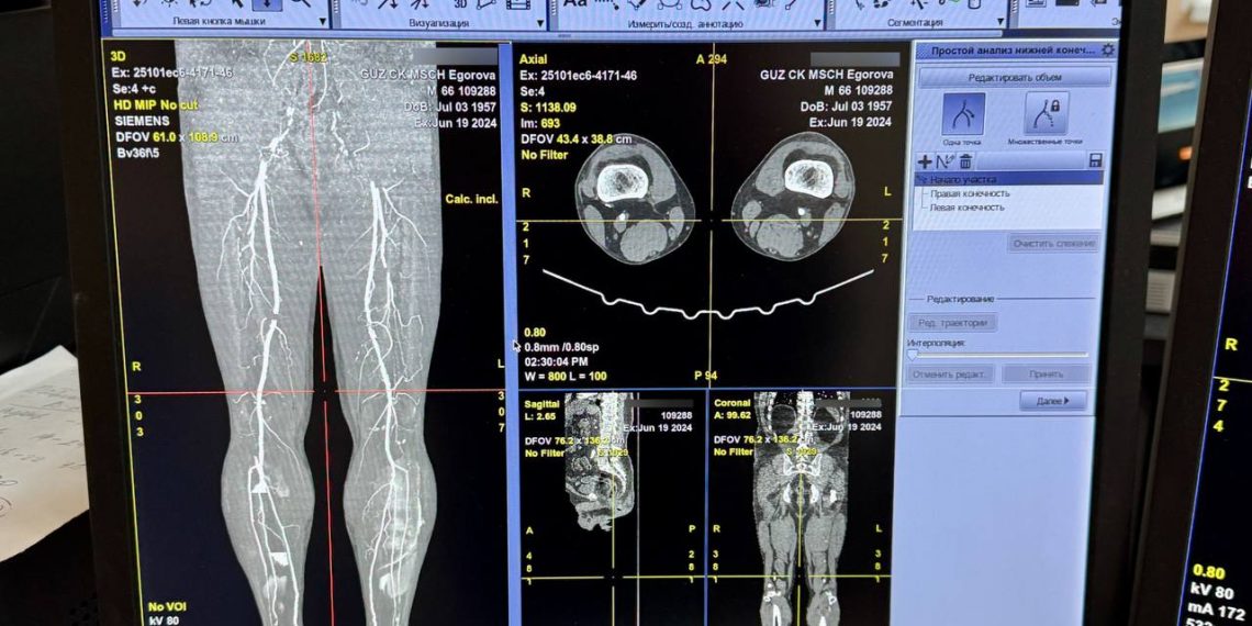 Ульяновские врачи спасли от ампутации ногу пациента-диабетика