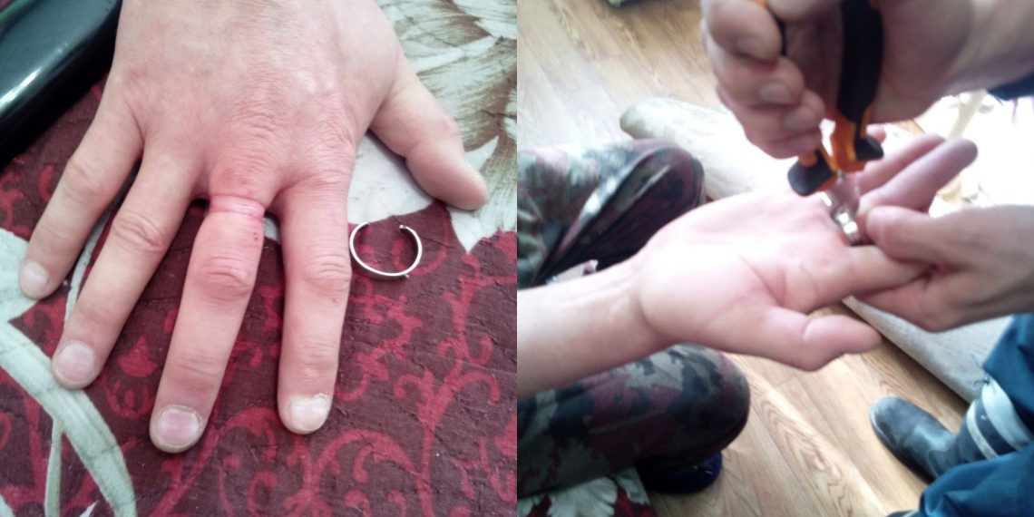 Спасатели помогли ульяновцу снять кольцо с распухшего пальца