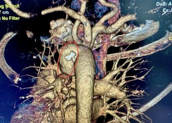 Бдительность ульяновских врачей предотвратила смерть пациентки