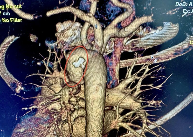 Бдительность ульяновских врачей предотвратила смерть пациентки