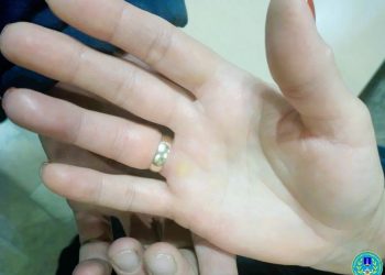 Ульяновские спасатели освободили палец женщины от зажавшего кольца