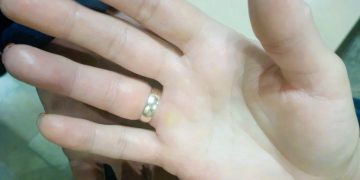 Ульяновские спасатели освободили палец женщины от зажавшего кольца