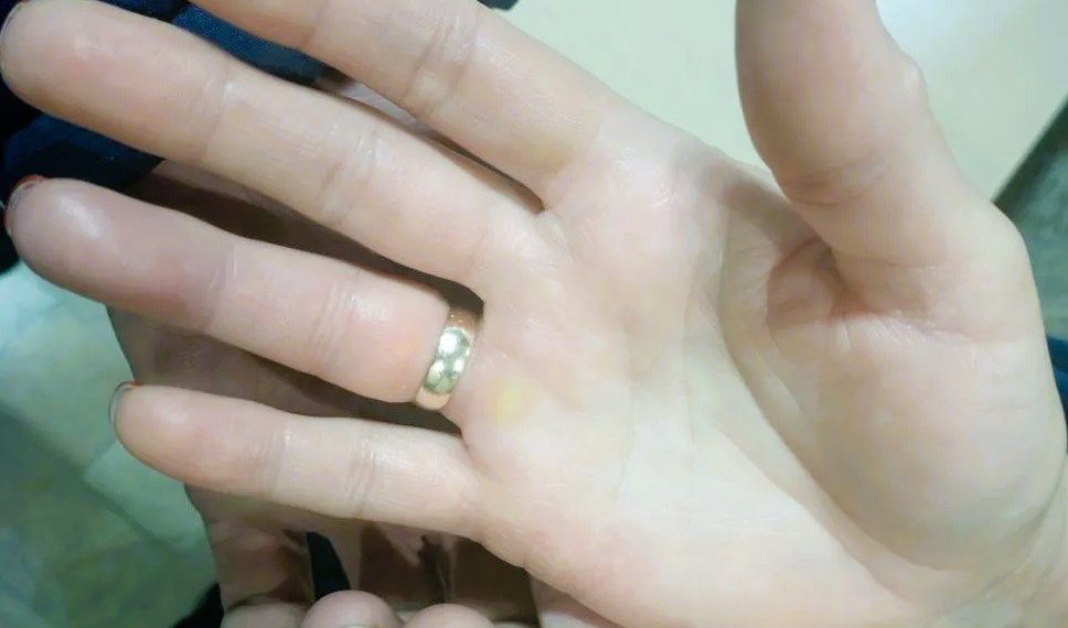 Ульяновские спасатели освободили палец женщины от зажавшего кольца