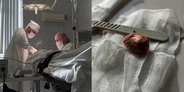 Ульяновские хирурги удалили из слюнной железы пациента гигантский камень